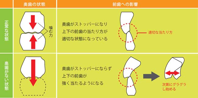 前歯がグラグラする原因｜東京入れ歯研究所